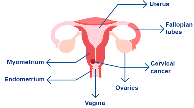 Cervical cancer