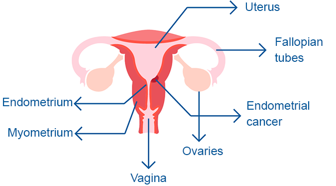 Endometrial cancer