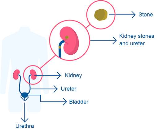 Kidney stones