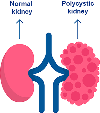 Polycystic kidney disease